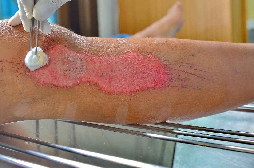 Wound Assessment & Documentation Training (1.0 CE)